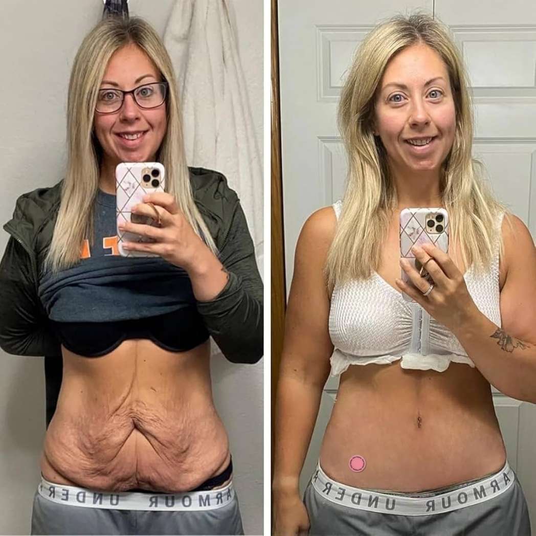 Loecare GLP-1 Adesivos (30 + 60 GRÁTIS)